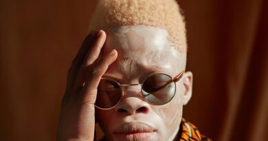 Chasse aux Albinos en Afrique : entre superstitions et violence